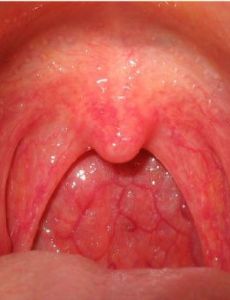 Sore throat