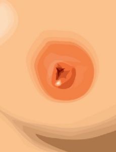 Nipple bleb