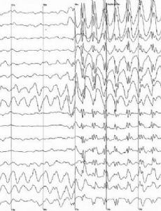 Electroencephalography