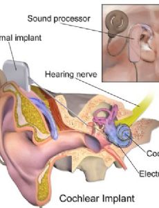 Cochlear implant