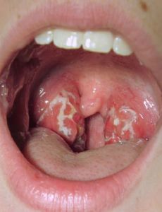 Tonsillitis
