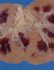 Kidney disease