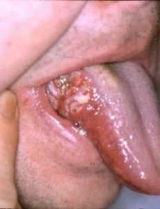 Oral cancer