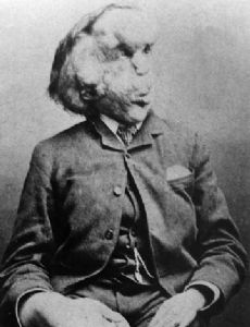 Joseph Merrick