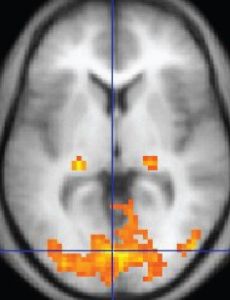 Functional magnetic resonance imaging