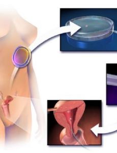 Assisted reproductive technology