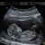 Ultrasound