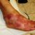 Inflammations