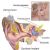 Cochlear implant